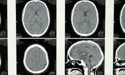 Uykunun REM evresine geçişte zorlanmak, alzheimer belirtisi olabilir