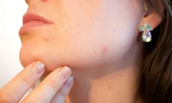 Stres, geçmeyen aknelerin başlıca sebebi olabilir