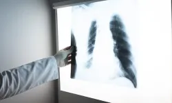 Türkiye’de tüberküloz vaka sayısı 9 bine düştü