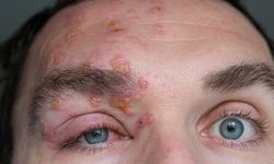 Zona hastalığı nedir ve nasıl ortaya çıkar?