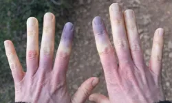 Ciltteki mavilik masum olmayabilir