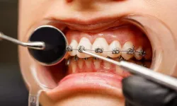 Braket nedir? Diş teli braket çeşitleri nelerdir?