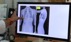 Çocuklarda skolyoz hastalığı ağrı vermeden ilerleyebilir