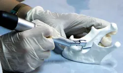 Obezite diş implantında komplikasyon riskini artırabiliyor