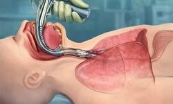 Entübe nedir? Entübasyon hangi durumlarda uygulanır?