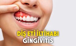 Diş eti iltihabı (Gingivitis) nedir?