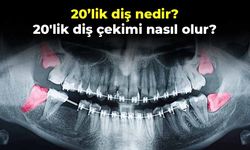 20’lik diş nedir? 20'lik diş çekimi nasıl olur?