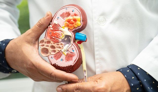 Böbrek taşına karşı alınması gereken 4 basit önlem