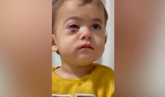 Bursa’da 2 yaşındaki çocuk sağ gözünü kaybetti