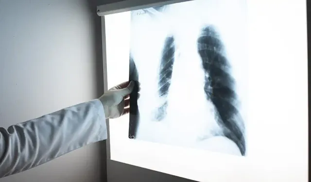 Türkiye’de tüberküloz vaka sayısı 9 bine düştü