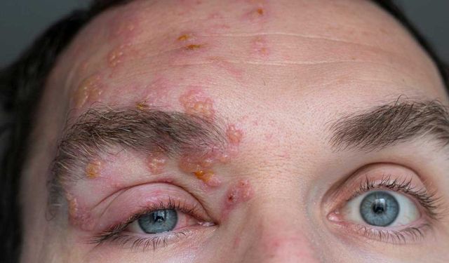 Zona hastalığı nedir ve nasıl ortaya çıkar?