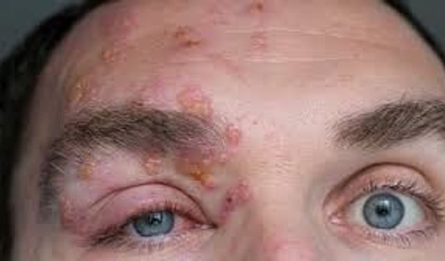 Zona hastalığı nedir? Belirtileri nelerdir?