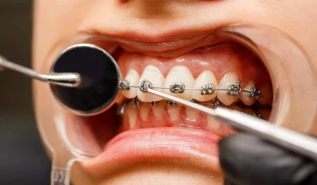 Braket nedir? Diş teli braket çeşitleri nelerdir?