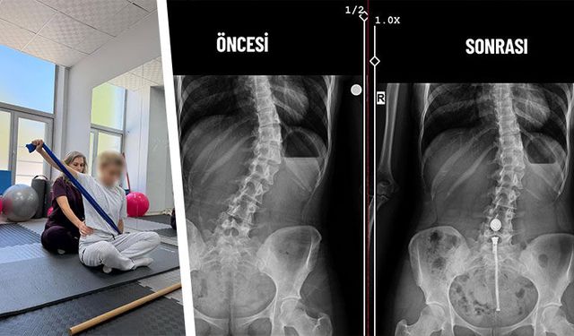 Kütahya’da skolyoz tedavisinde bir ilk gerçekleştirildi