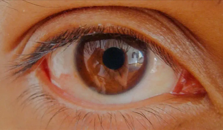 Göz tansiyonunda erken teşhis kalıcı körlüğü önlüyor