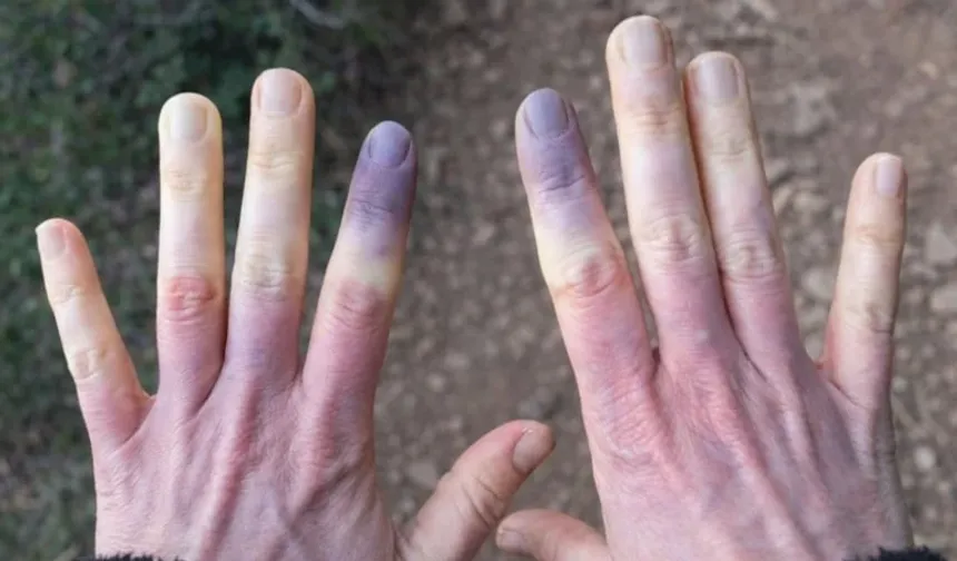 Ciltteki mavilik masum olmayabilir