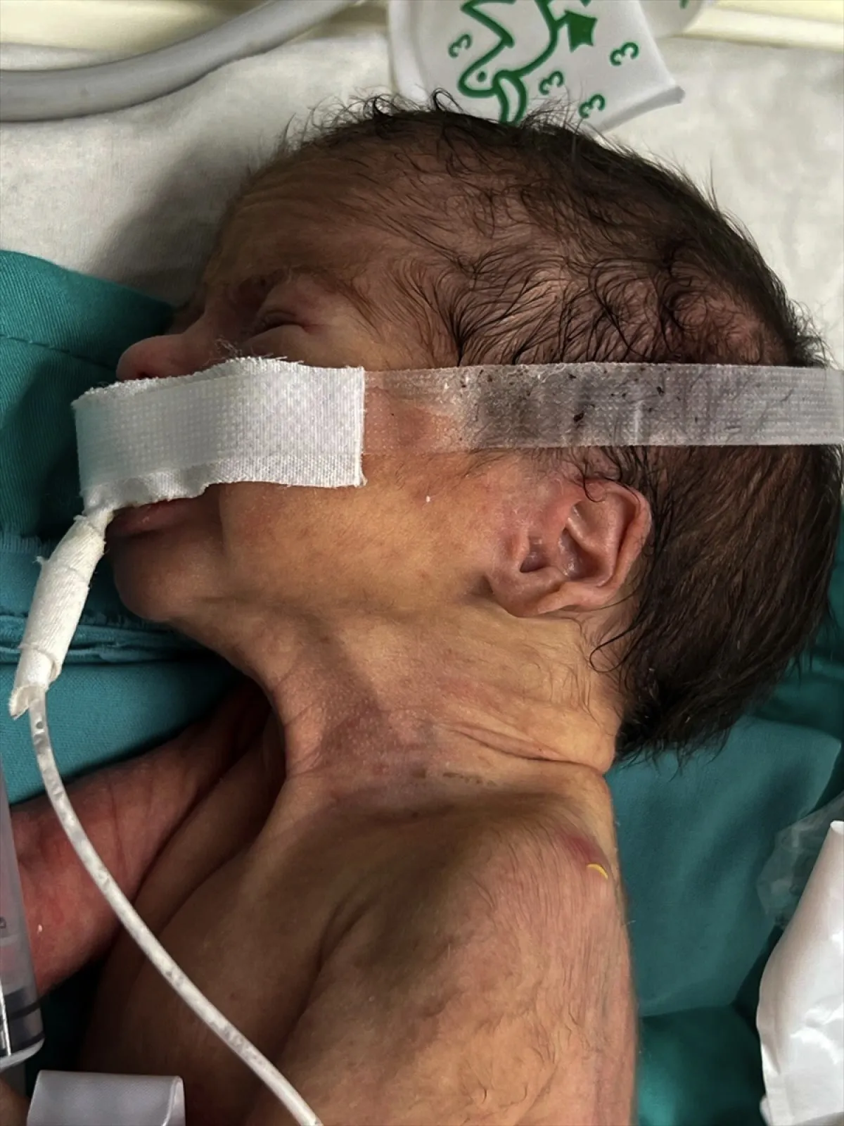 Gazze'de Tıbbi Malzeme Krizi1