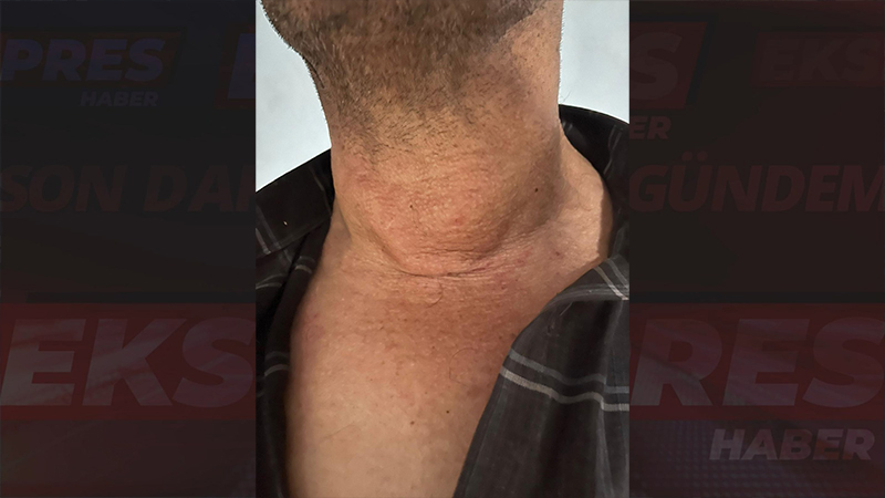 İzmir’den Gelen Devasa Guatrlı Hasta Kütahya’da Sağlığına Kavuştu (3)