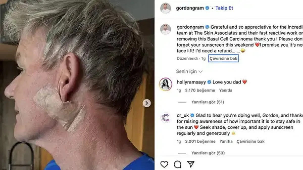 Ünlü Şef Gordon Ramsay Cilt Kanserine Yakalandı