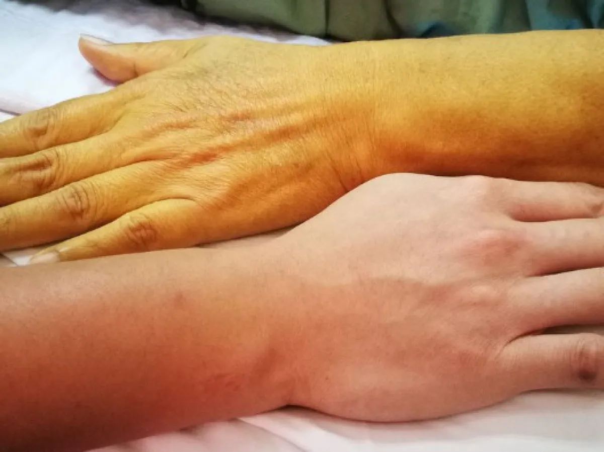 Bu 4 Belirtiyle Karaciğeriniz Alarm Veriyor Olabilir 1