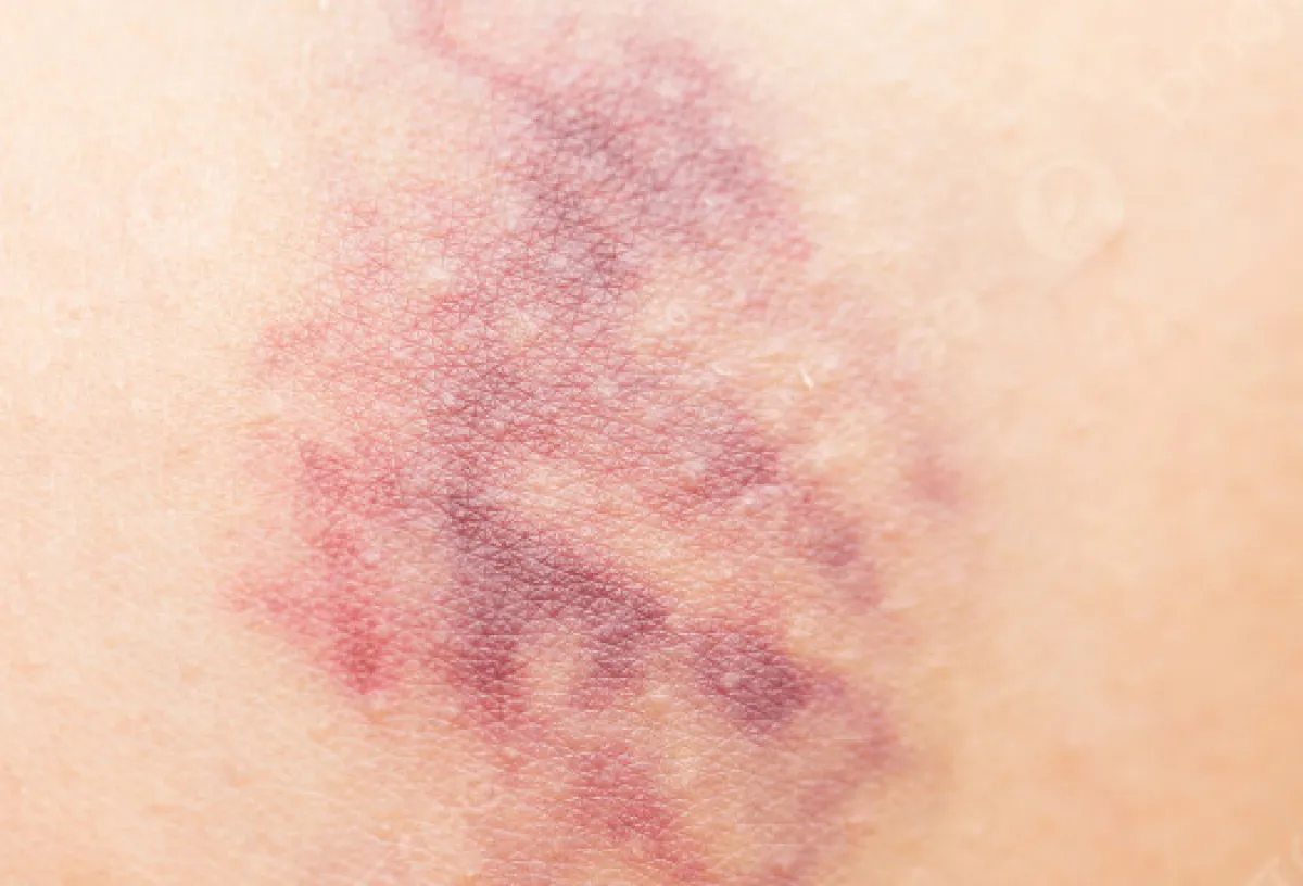 Bu 4 Belirtiyle Karaciğeriniz Alarm Veriyor Olabilir 4