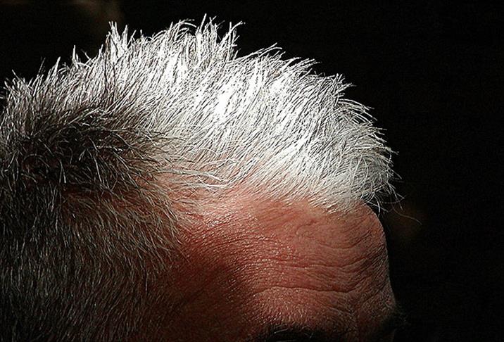 İnce, Yağlı Veya Seyrek Saç Sağlığınızın Işareti Olabilir 3