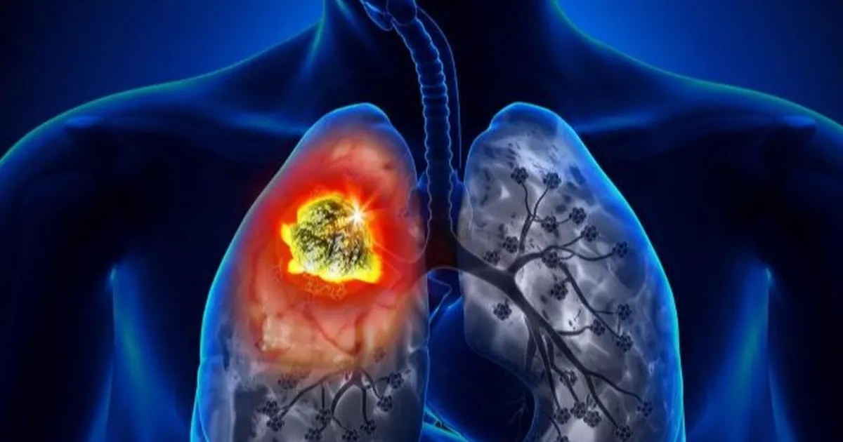 Akciğer Kanserinde Erken Teşhis Hayat Kurtarıyor2