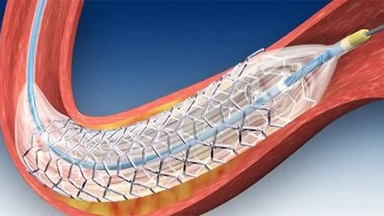 Kalp Ve Damar Hastalıklarında Stentsiz Tedavi Imkanı1