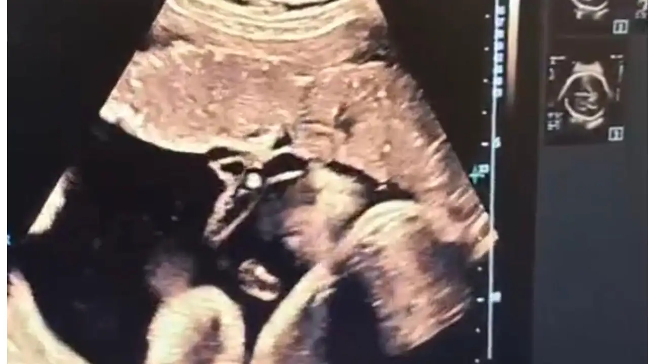 Kütahya'da Anne Karnındaki Bebeğe Kan Nakli Yapıldı3