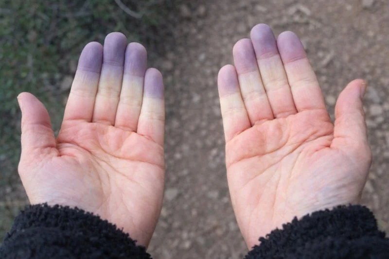 Ciltteki Mavilik Masum Olmayabilir1