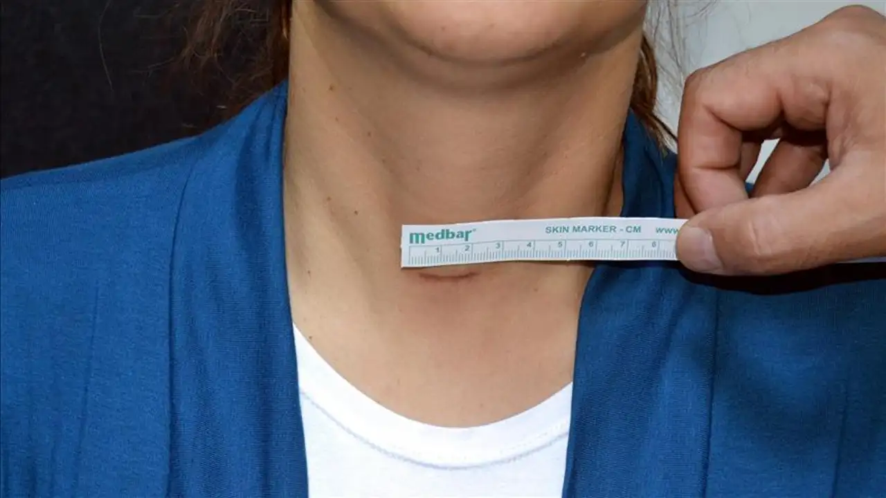 Tiroid Kanserinde Erken Uyarı Veren Belirtiler 1