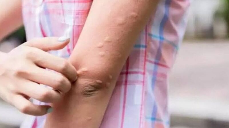 Sivrisinekler Neden Bazı Insanları Daha Çok Isırıyor3