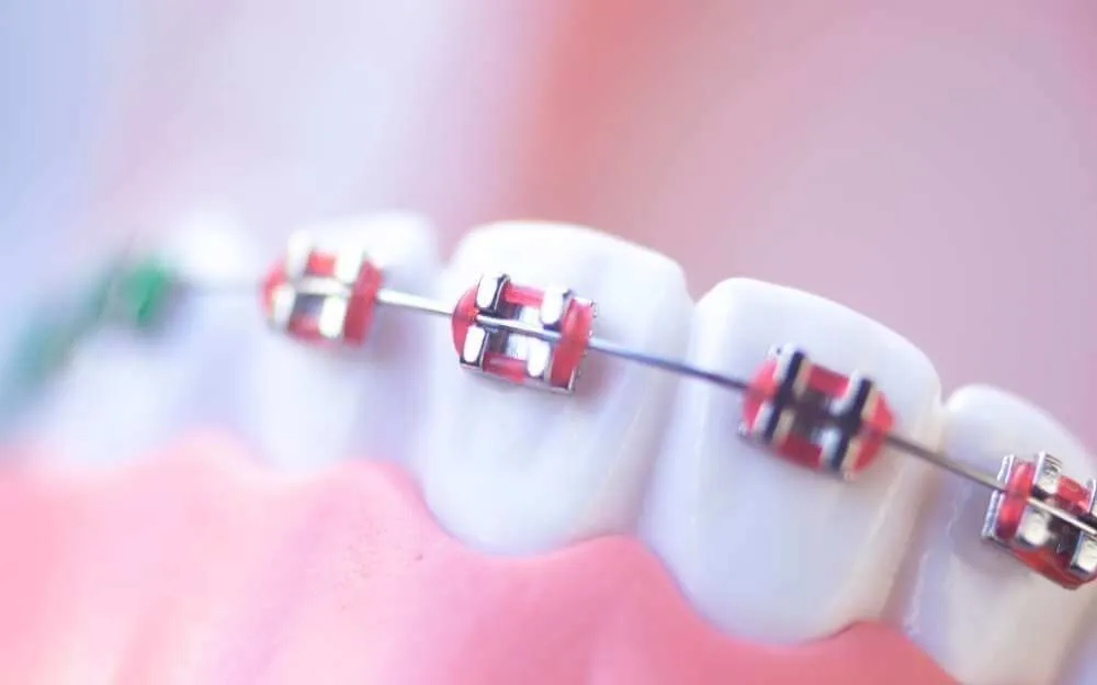 Braket Nedir? Diş Teli Braket Çeşitleri Nelerdir?