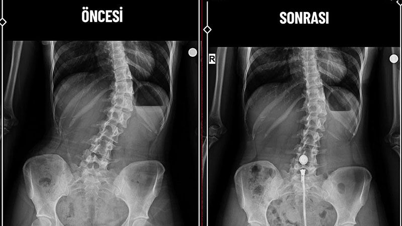 Kütahya’da Skolyoz Tedavisinde Bir Ilk Gerçekleştirildi (3)