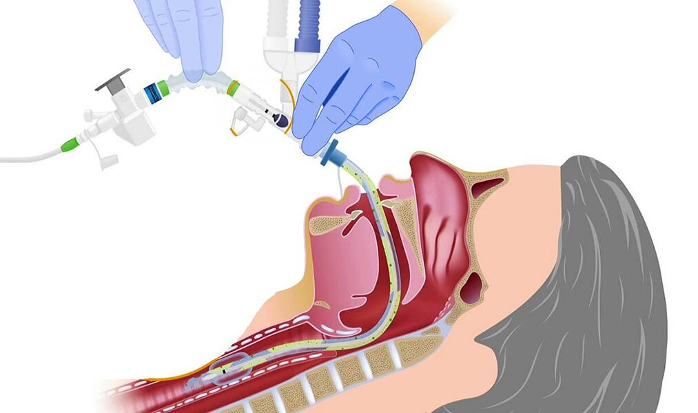 Entübe Nedir? Entübasyon Hangi Durumlarda Uygulanır?4