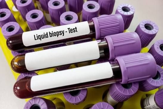 Sıvı Biyopsi Kanserde Tedavi Değişikliğini Erkenden Belirleyebiliyor1