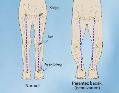 Çocuklarda yürüme bozuklukları: Paytak yürüme bozukluğu