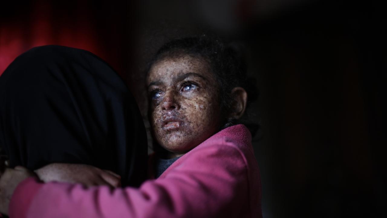 Güneşe Çıkamama Hastalığı